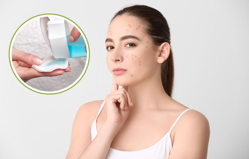 Da bị mụn có nên dùng toner không là điều nhiều người muốn biết
